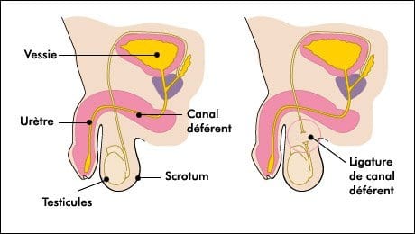 vasectomie