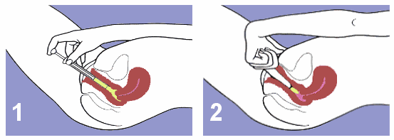 spermicide