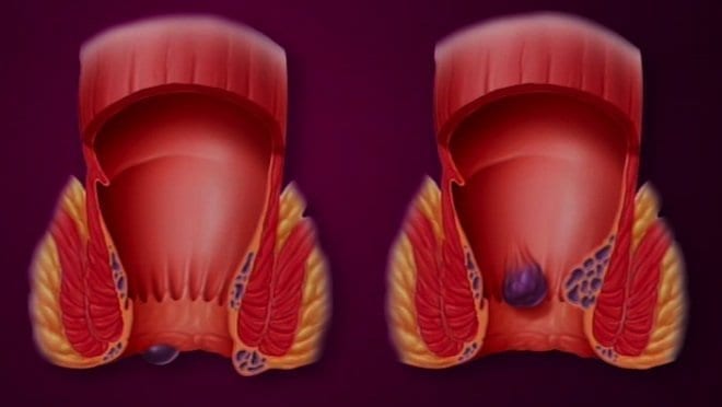 hemorroides internes et externes