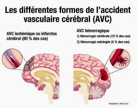 differentes formes AVC