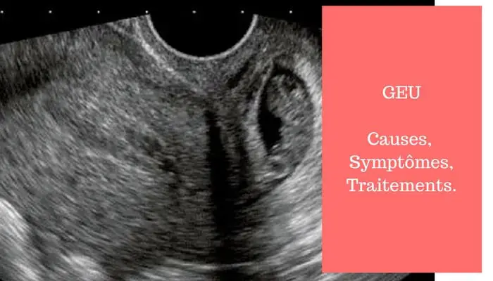 echographie grossesse extra uterine