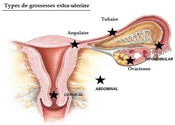 types grossesse extra uterine