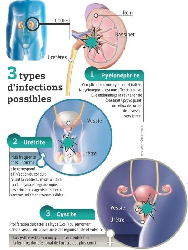 types infection urinaire