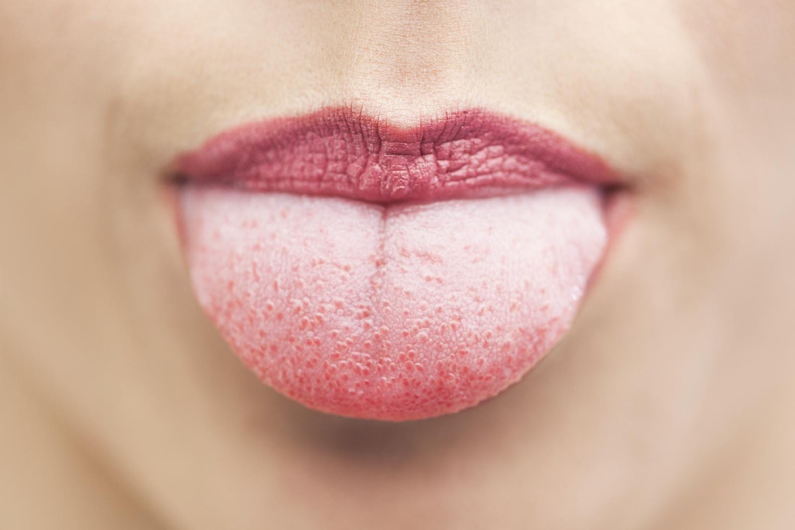 Langue blanche malodorante 9 causes fréquentes, 6 solutions possibles