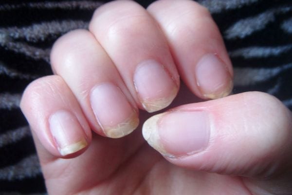 ongles qui se dedoublent