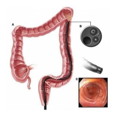 coloscopie schema