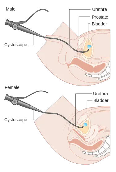 cystoscopie HOMME ET FEMME