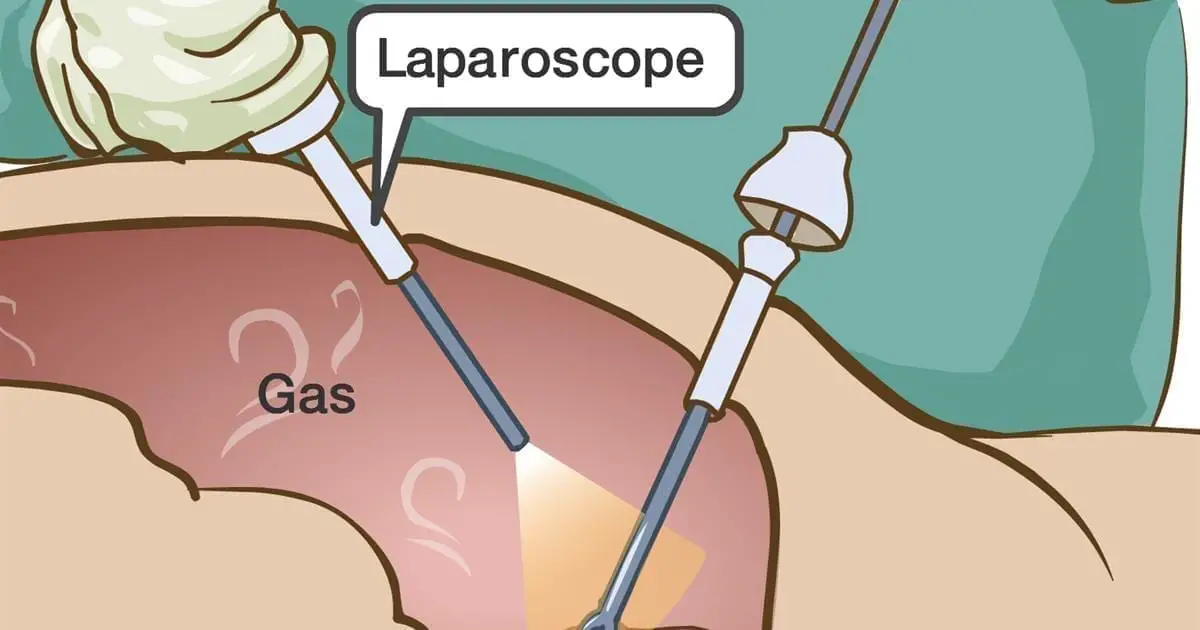 laparoscopie bande dessinee