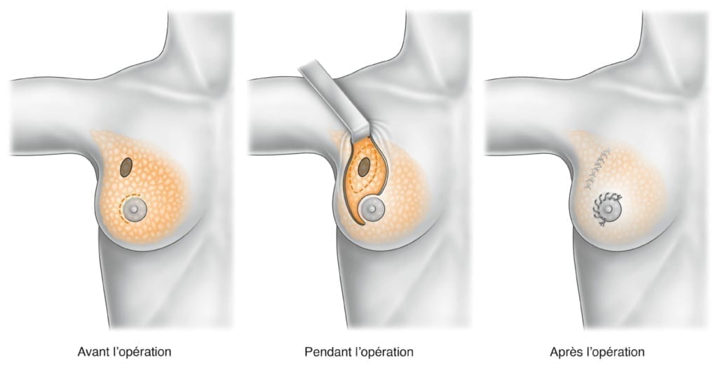 reconstruction mammaire