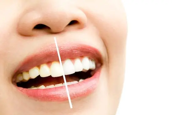 dents blanches avant après