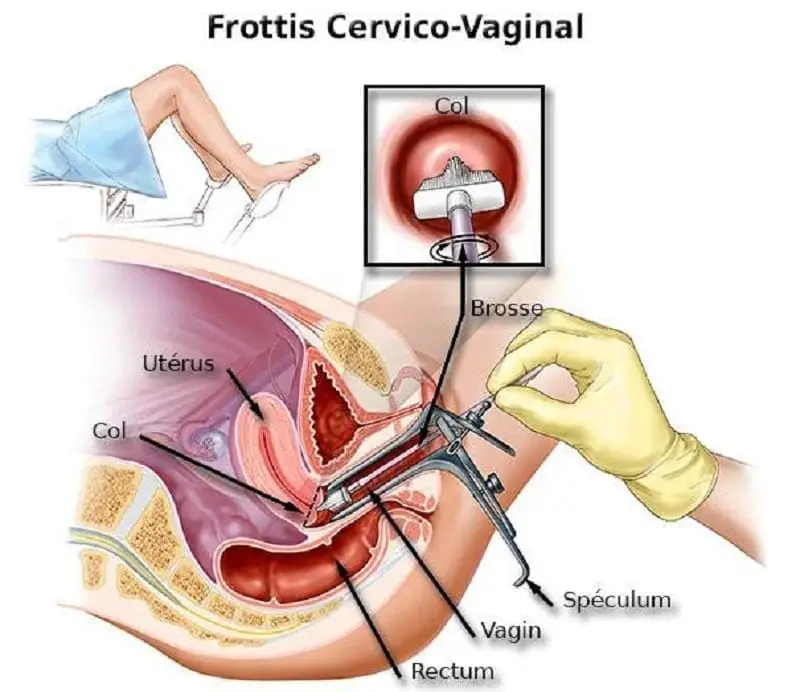 frottis cervico vaginal