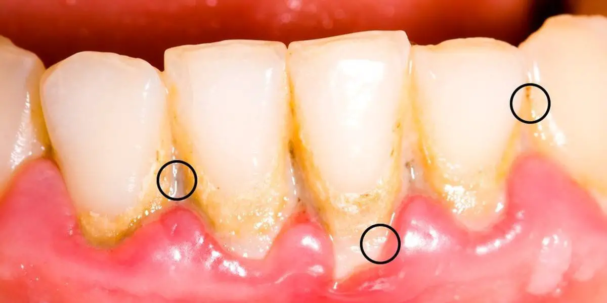 Dents jaunes causes et solutions possibles pour des dents plus blanches