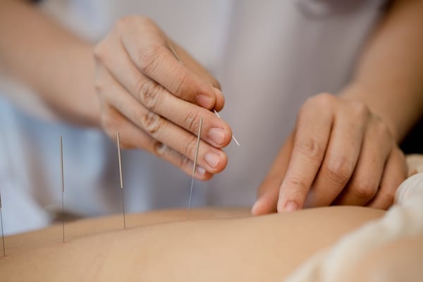 acupuncture